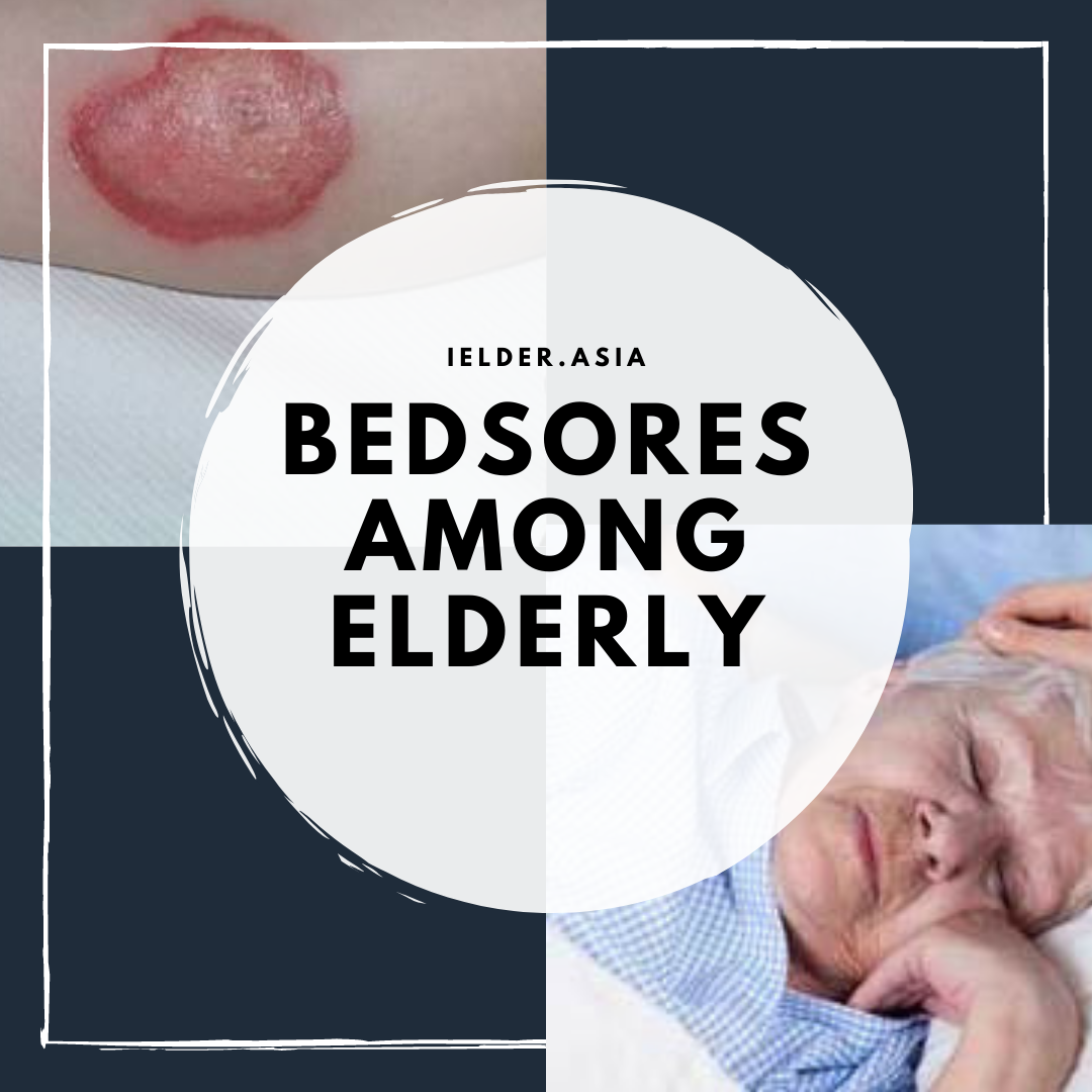 Bedsores Among Elderly