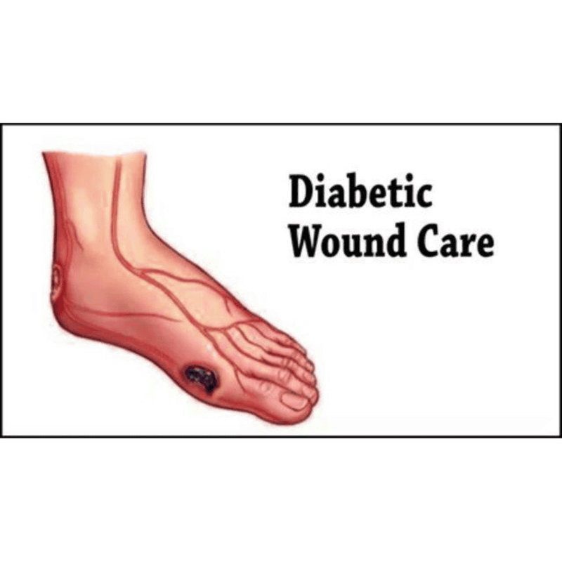 Physiotherapy Treatment: Diabetic Wound (Laser Therapy)