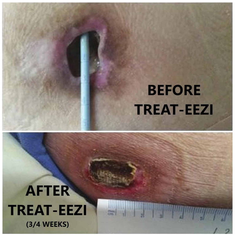 Pressure Sore Mattress Overlay | Treat-Eezi
